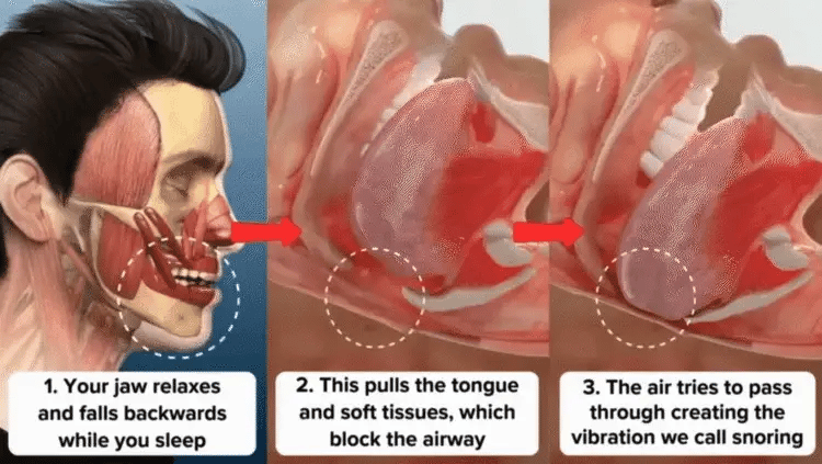 🔥✨PerfectSleep Solution- Anti-Snoring & Anti-Grinding Teeth Protector