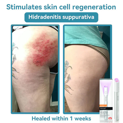 ✨QIAWI™ All-in-One CO₂ Laser Eraser Pen | Removes Moles, Warts, Skin Flaws & Pigmentation（fb）