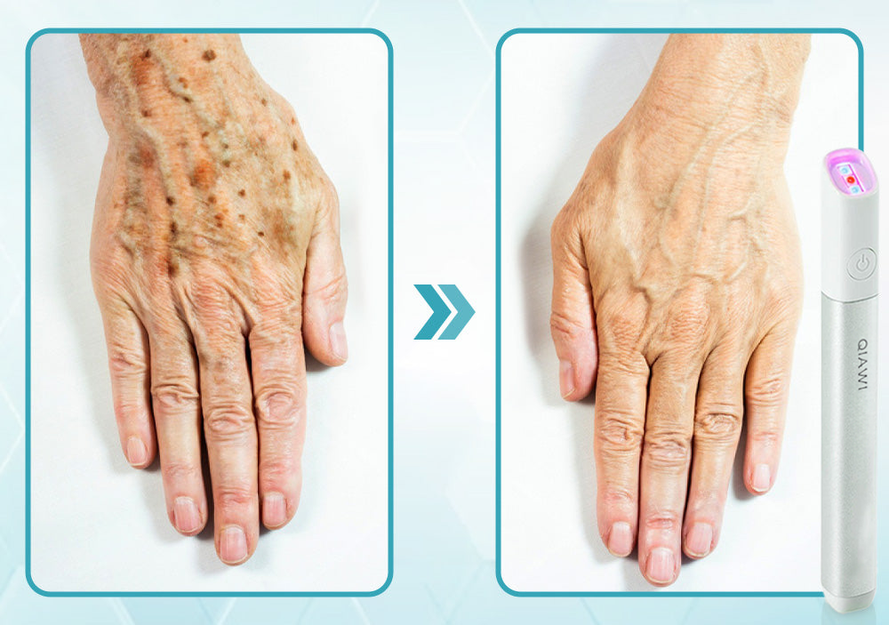 ✨QIAWI™ All-in-One CO₂ Laser Eraser Pen | Removes Moles, Warts, Skin Flaws & Pigmentation（fb）