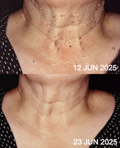 ✨QIAWI™ All-in-One CO₂ Laser Eraser Pen | Removes Moles, Warts, Skin Flaws & Pigmentation（fb）