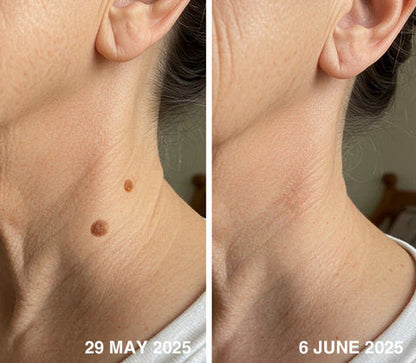 ✨QIAWI™ All-in-One CO₂ Laser Eraser Pen | Removes Moles, Warts, Skin Flaws & Pigmentation（fb）